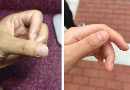 长春哪里治灰指甲好还便宜