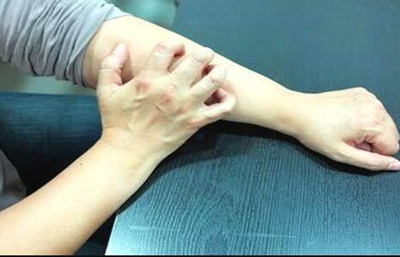 为什么荨麻疹一到晚上就更痒