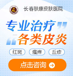 长春皮肤科医院,激素过敏性皮炎治疗方法
